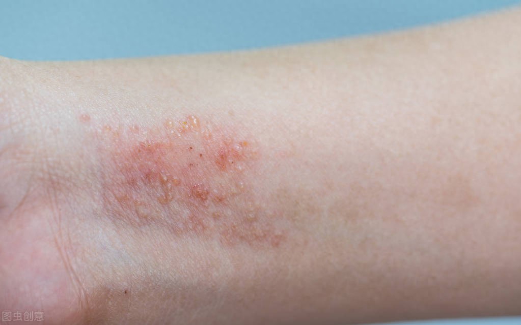 顽固湿疹治疗_湿疹 根治_湿疹反复发作原因