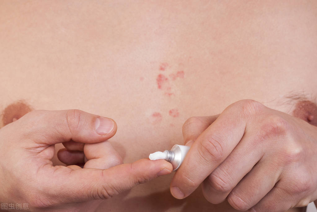 顽固湿疹治疗_湿疹 根治_湿疹反复发作原因
