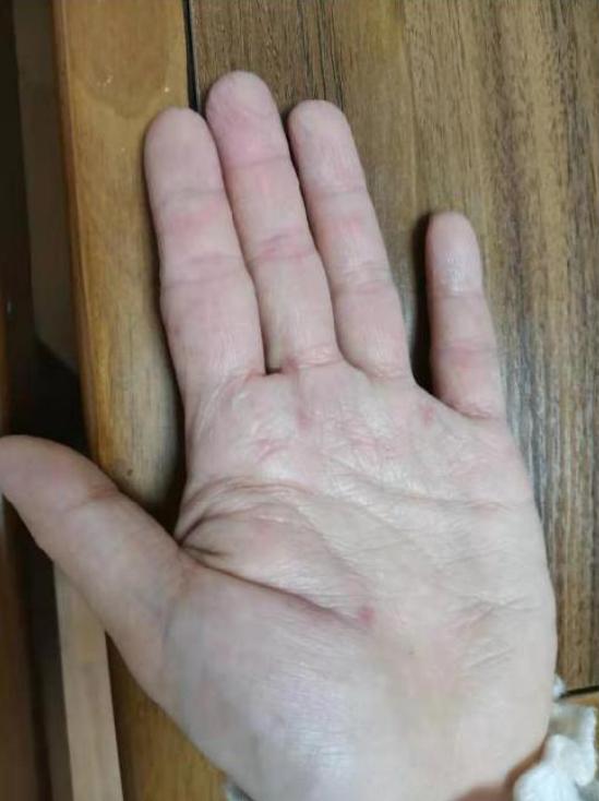 湿疹中医治疗_失眠伴湿疹治疗_湿疹 根治