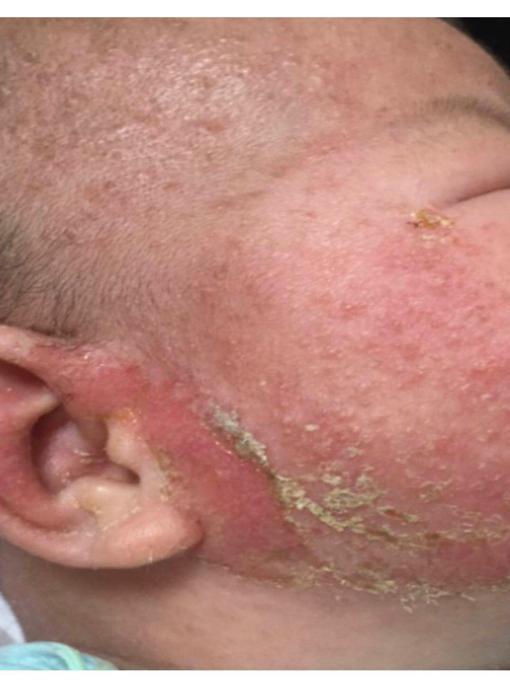 湿疹样皮疹剧烈瘙痒反复发作_湿疹 根治_湿疹护理保湿防过敏药物