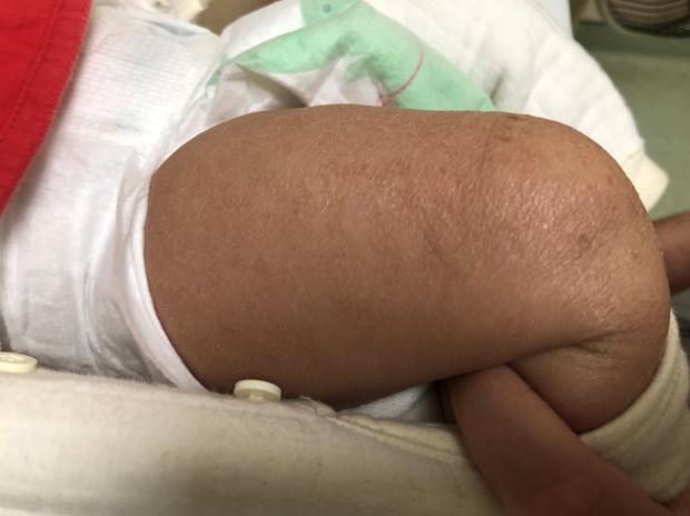 湿疹护理保湿防过敏药物_湿疹样皮疹剧烈瘙痒反复发作_湿疹 根治