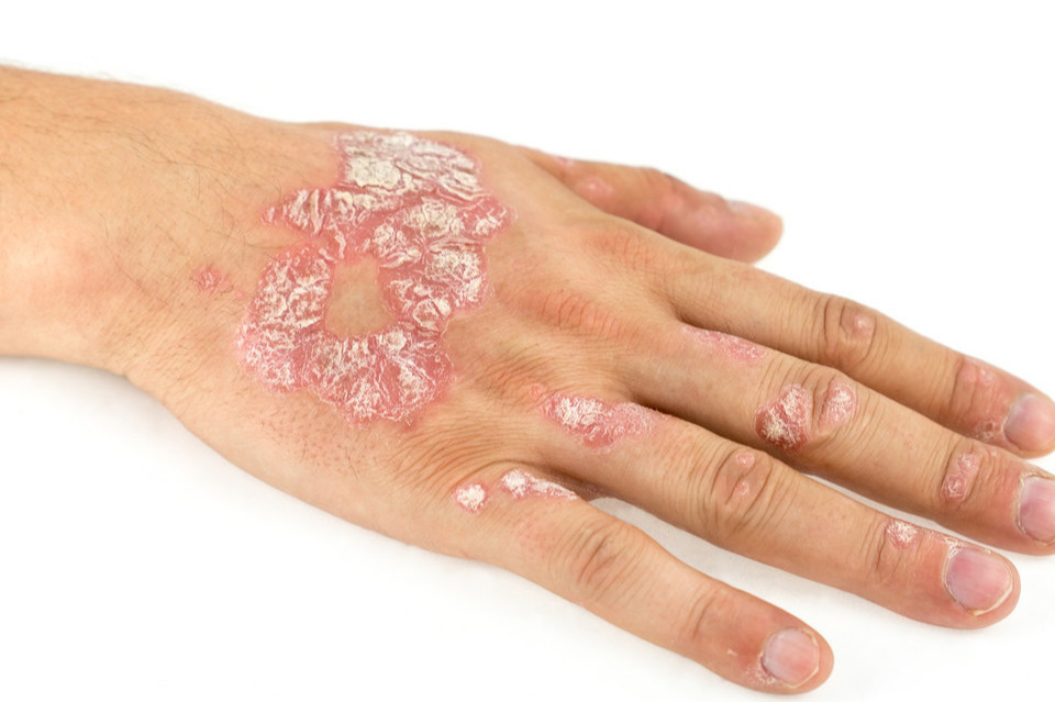 银屑病病因因素_银屑病诱发因素分析_湿疹 根治